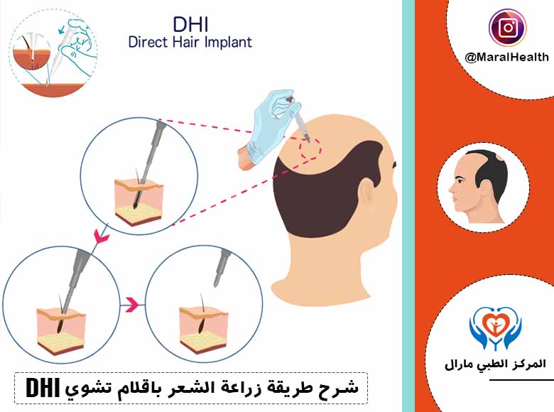 شرح طريقة زراعة الشعر باقلام تشوي - DHI