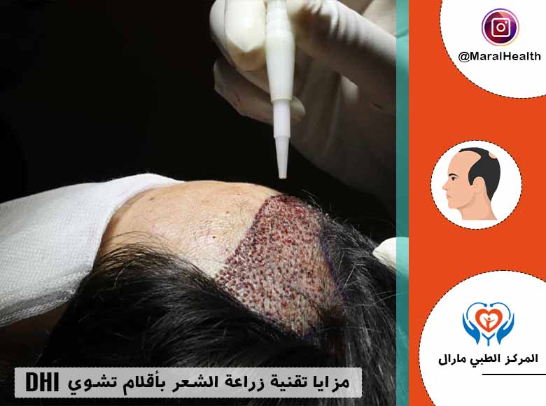 مزايا تقنية زراعة الشعر بأقلام تشوي DHI