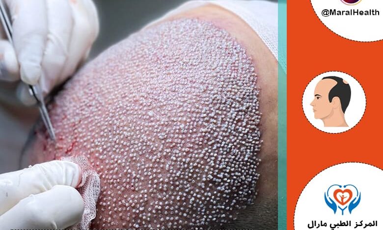 أحدث طرق و تقنيات زراعة الشعر في عام 2023 | المرکز الطبي مارال