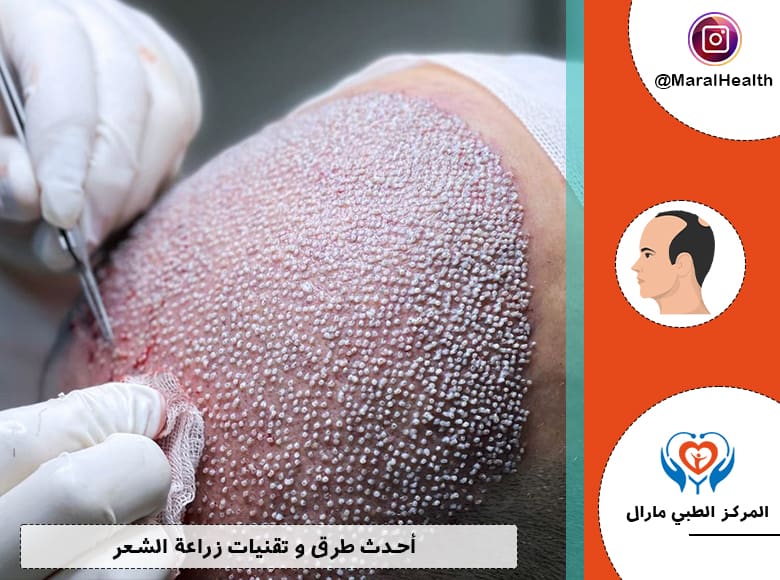 أحدث طرق و تقنيات زراعة الشعر في عام 2023 | المرکز الطبي مارال