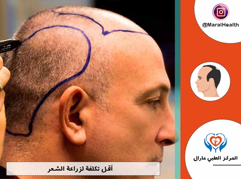 أقل تكلفة لزراعة الشعر