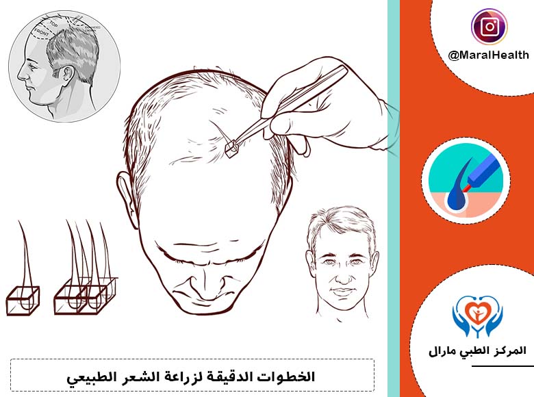 الخطوات الدقيقة لزراعة الشعر الطبيعي