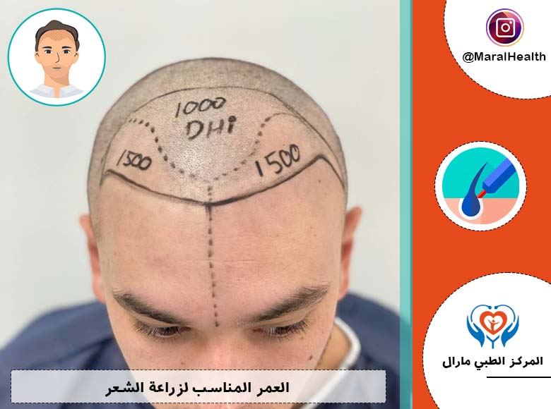العمر المناسب لزراعة الشعر
