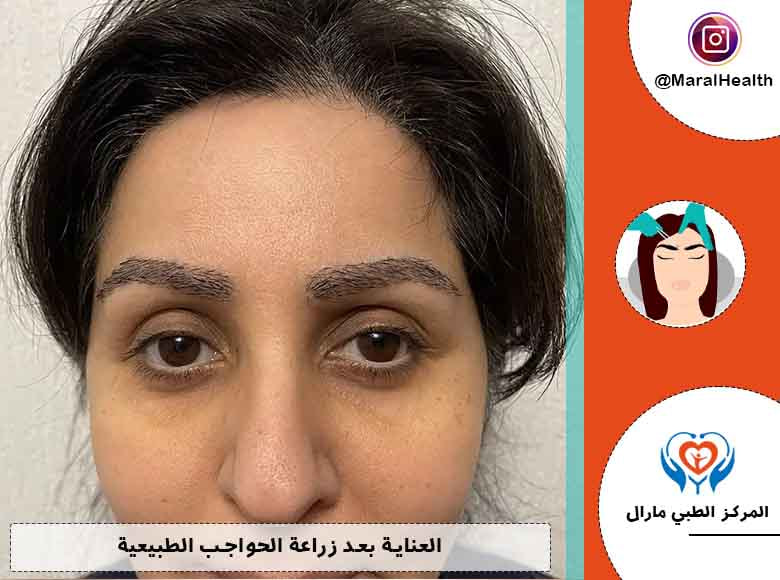 العناية بعد زراعة الحواجب الطبيعية