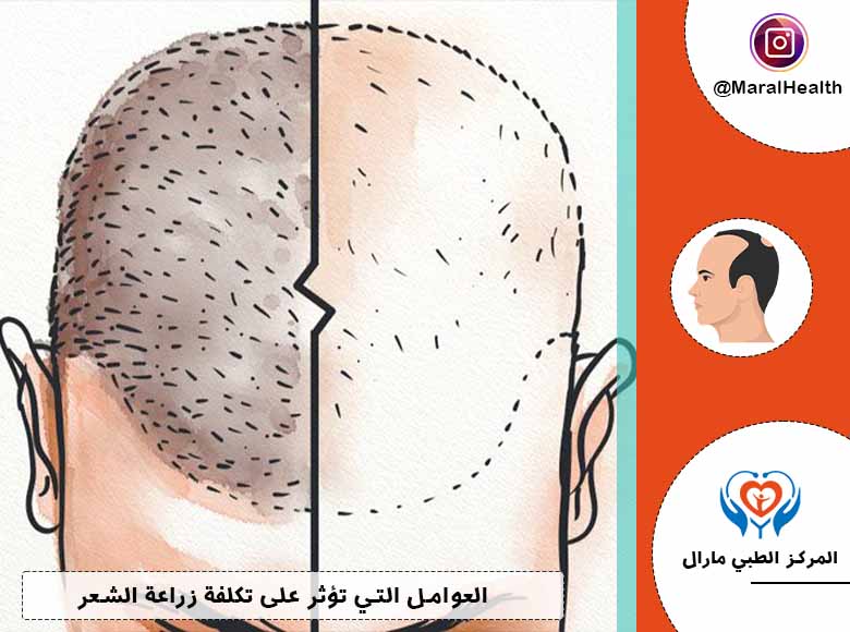 العوامل التي تؤثر على تكلفة زراعة الشعر