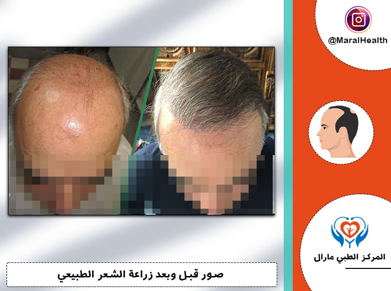 الفرق بين زراعة الشعر بتقنية السفير وتقنية الاقتطاف