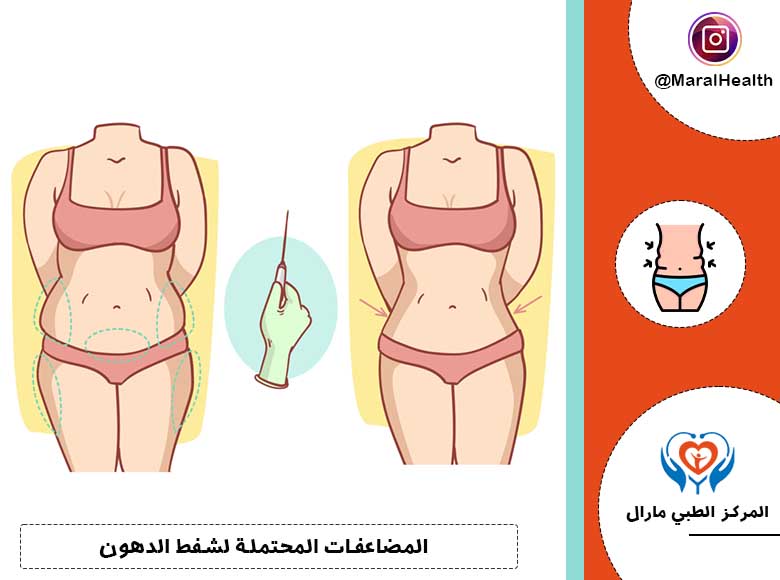 المضاعفات المحتملة لشفط الدهون