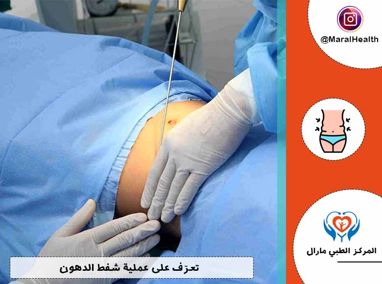 تعرّف على عملية شفط الدهون