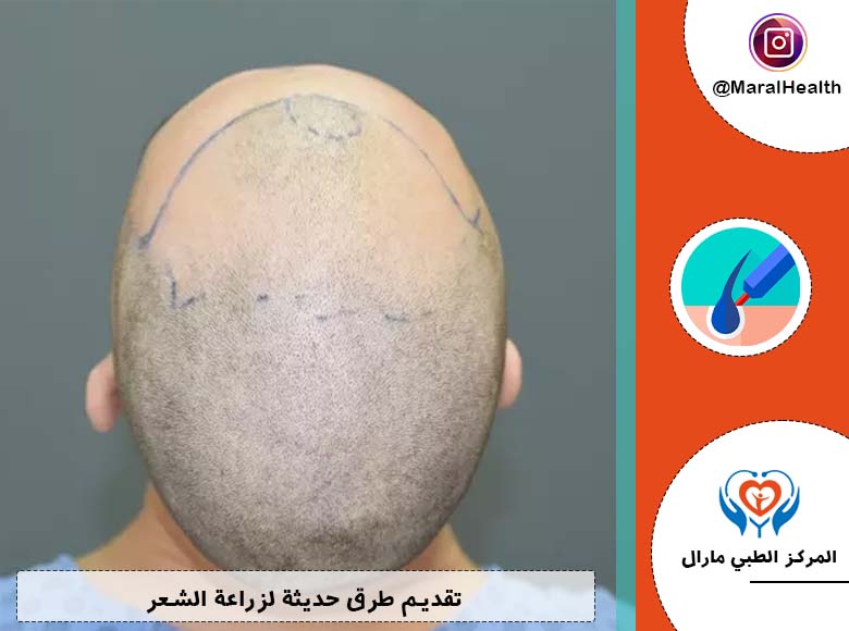 تقديم طرق حديثة لزراعة الشعر