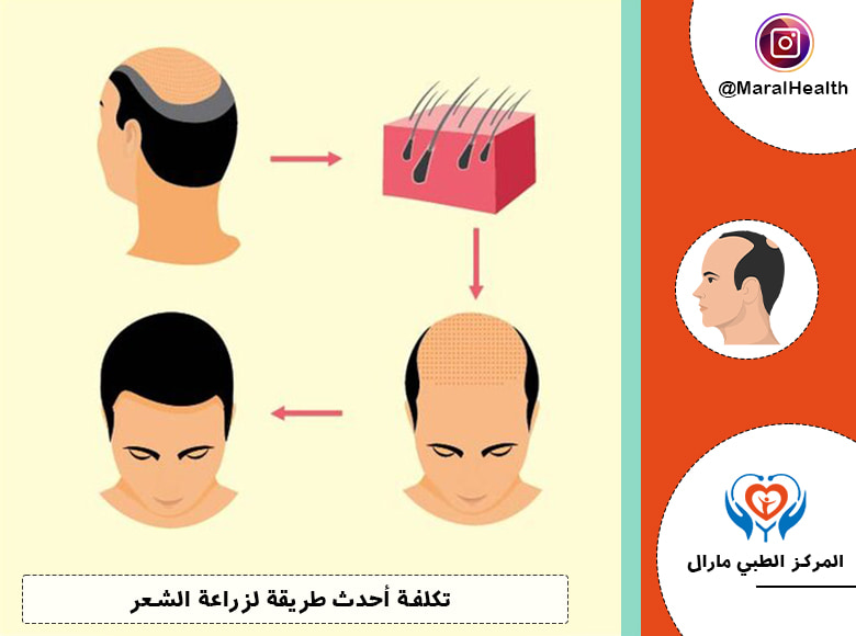 تكلفة أحدث طريقة لزرع الشعر