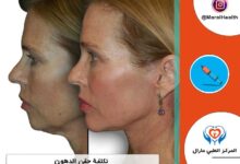 تكلفة حقن الدهون