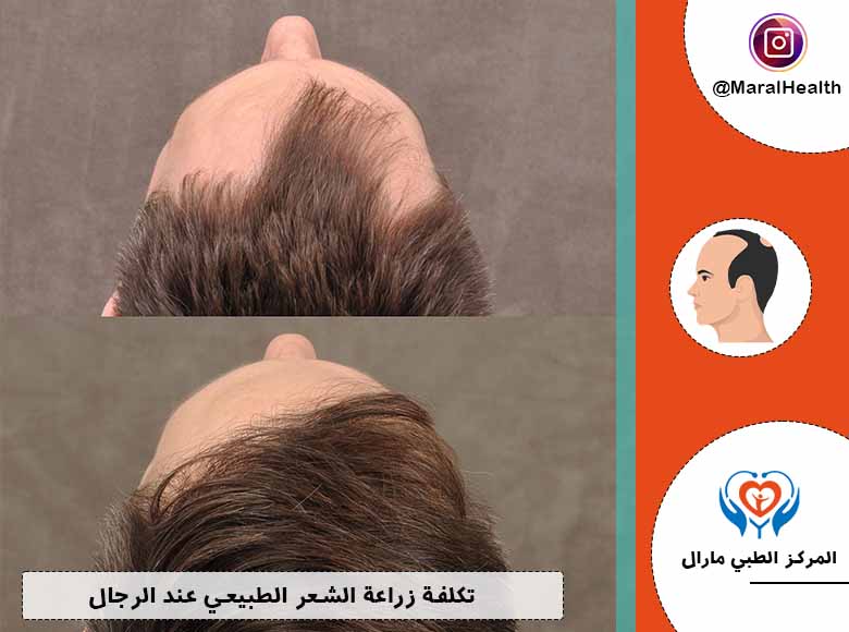 تكلفة زراعة الشعر الطبيعي عند الرجال