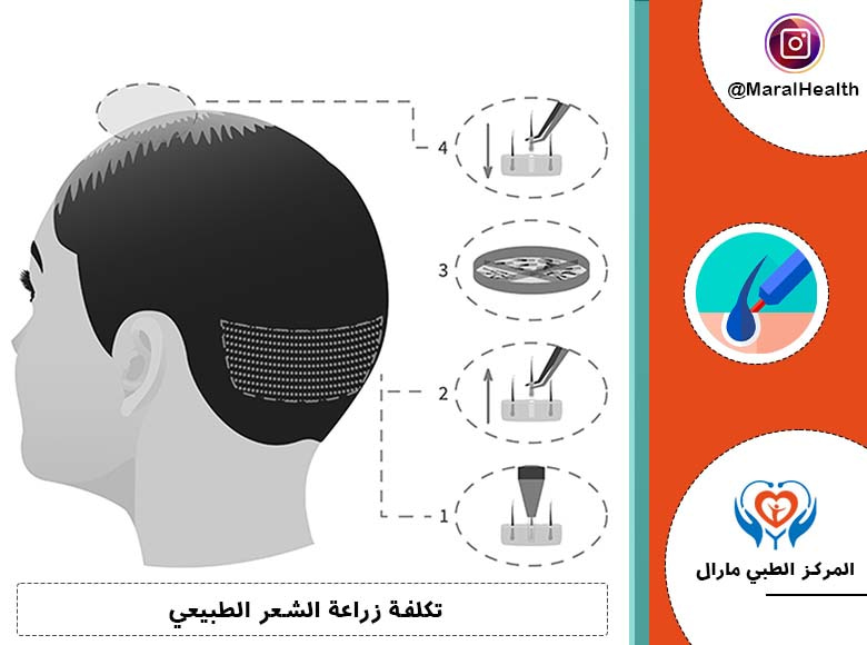 تكلفة زراعة الشعر الطبيعي