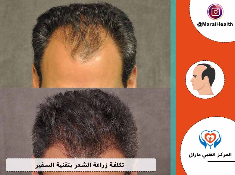 تكلفة زراعة الشعر بتقنية السفير