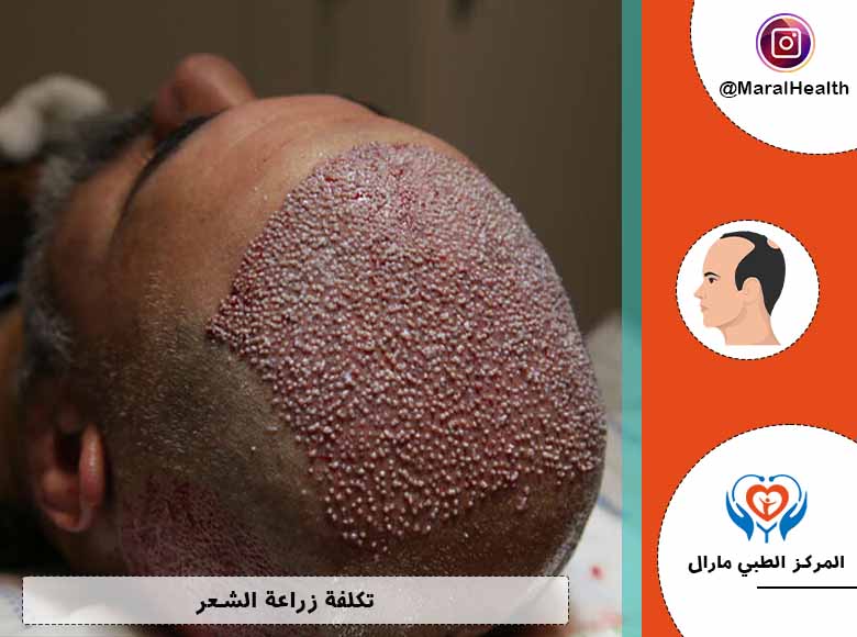 تكلفة زراعة الشعر - المرکز الطبي مارال | 2023
