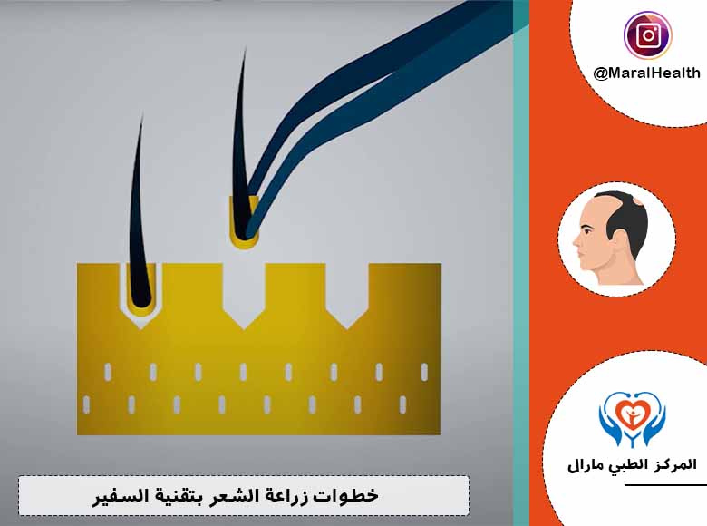 خطوات زراعة الشعر بتقنية السفير