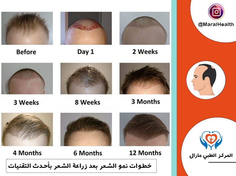 خطوات نمو الشعر بعد زراعة الشعر بأحدث التقنيات