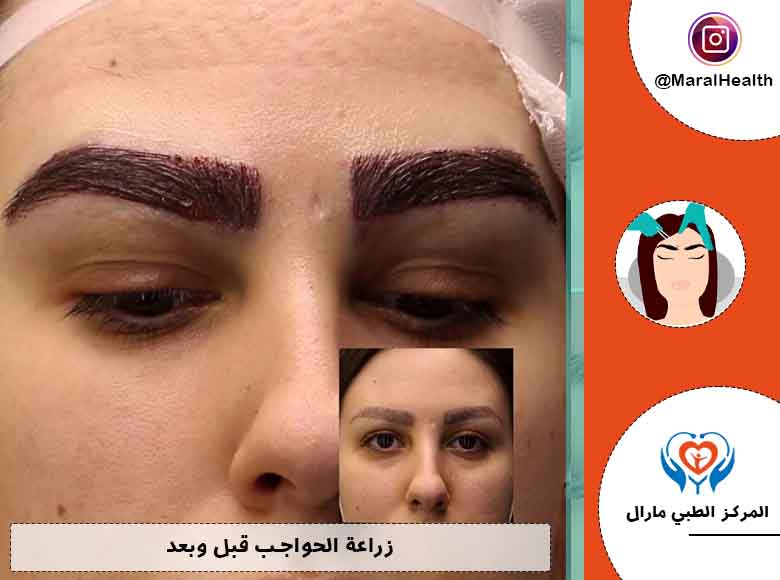زراعة الحواجب قبل وبعد