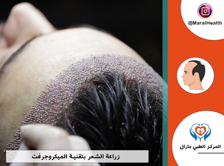 زراعة الشعر بتقنية الميكروجرفت (Micro Graft)