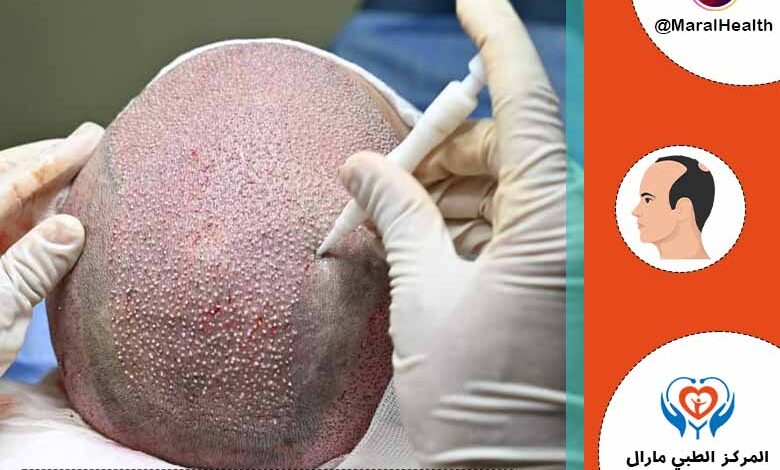 زراعة الشعر بتقنية أقلام تشوي DHI | المرکز الطبي مارال