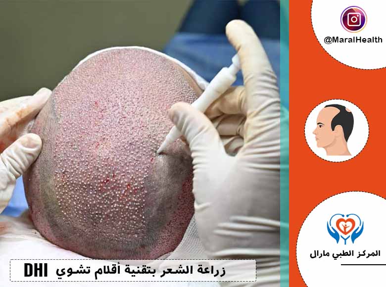 زراعة الشعر بتقنية أقلام تشوي DHI | المرکز الطبي مارال