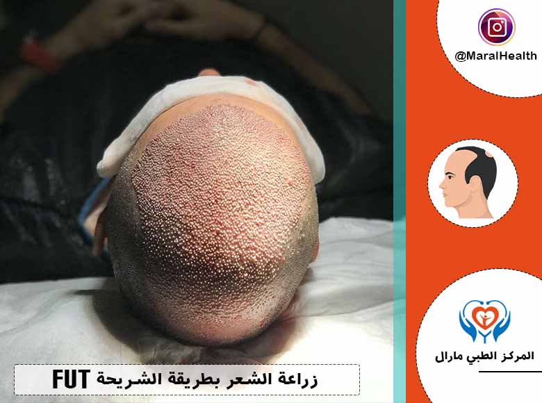 زراعة الشعر بطريقة الشريحة FUT | المرکز الطبي مارال