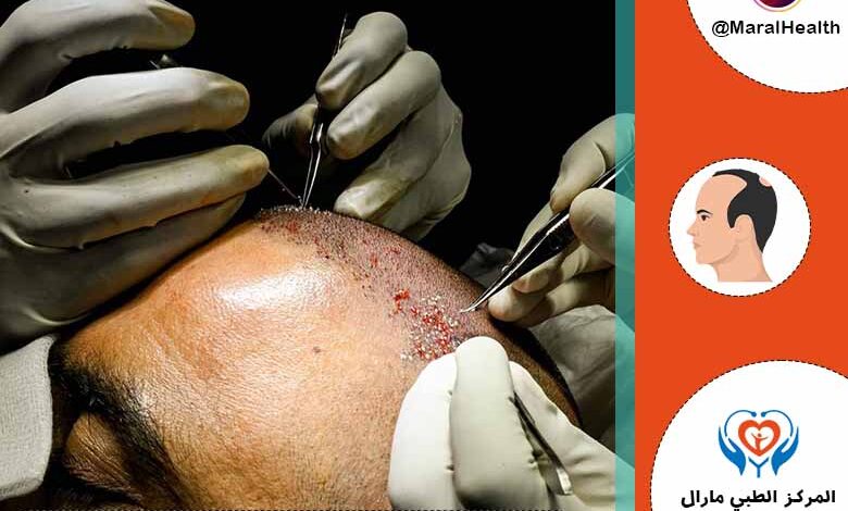 زراعة الشعر بتقنية الاقتطاف FUE | المرکز الطبي مارال