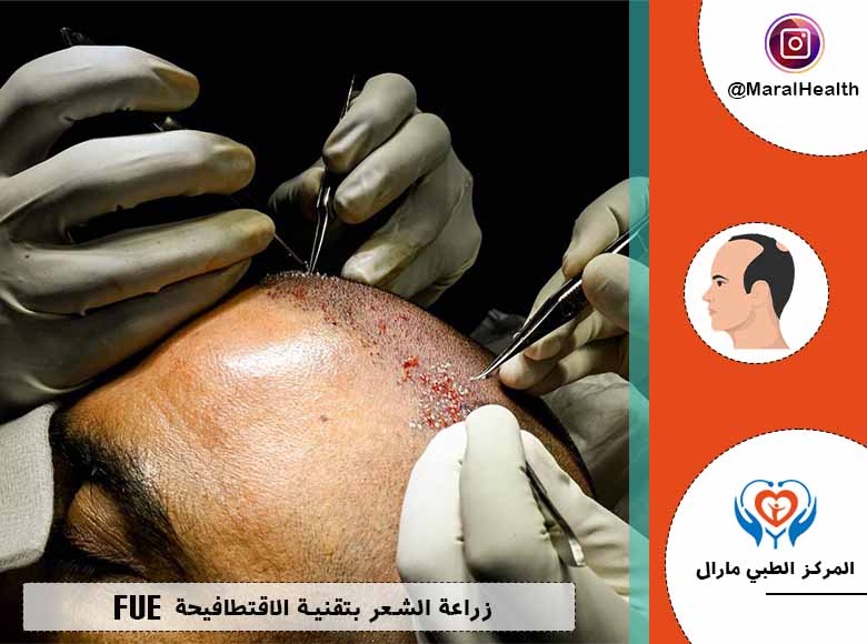 زراعة الشعر بتقنية الاقتطاف FUE | المرکز الطبي مارال