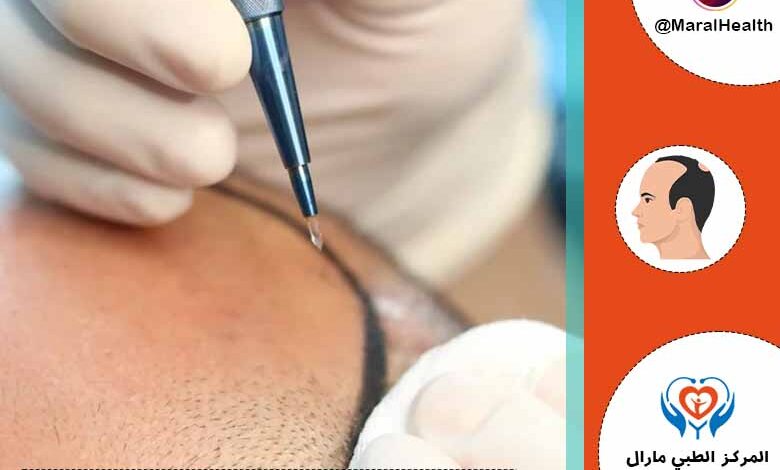 زراعة الشعر بتقنية السفير
