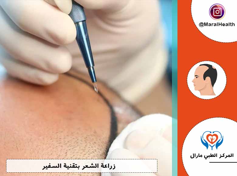 زراعة الشعر بتقنية السفير