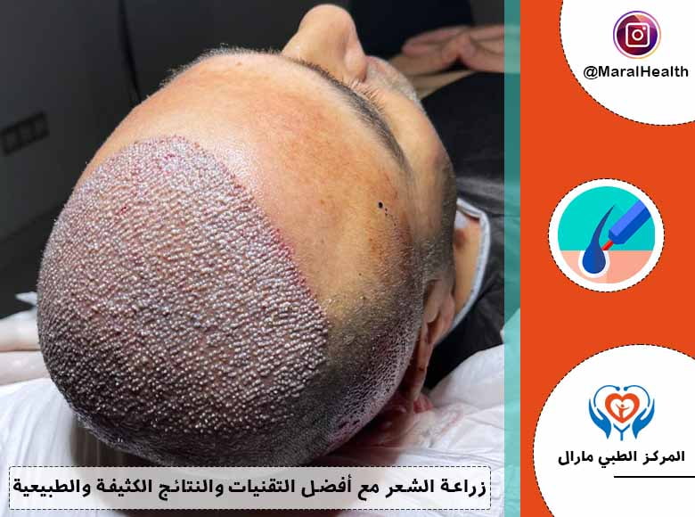 زراعة الشعر مع أفضل التقنيات والنتائج الكثيفة والطبيعية