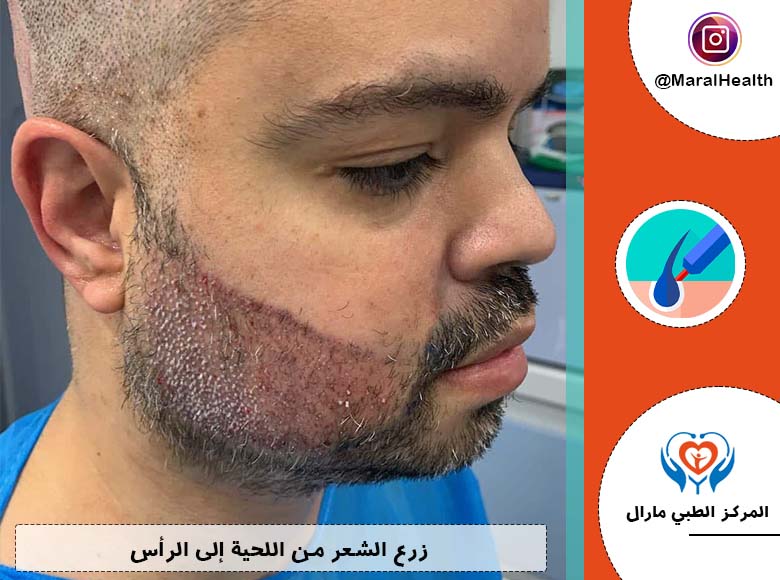 زرع الشعر من اللحية إلى الرأس