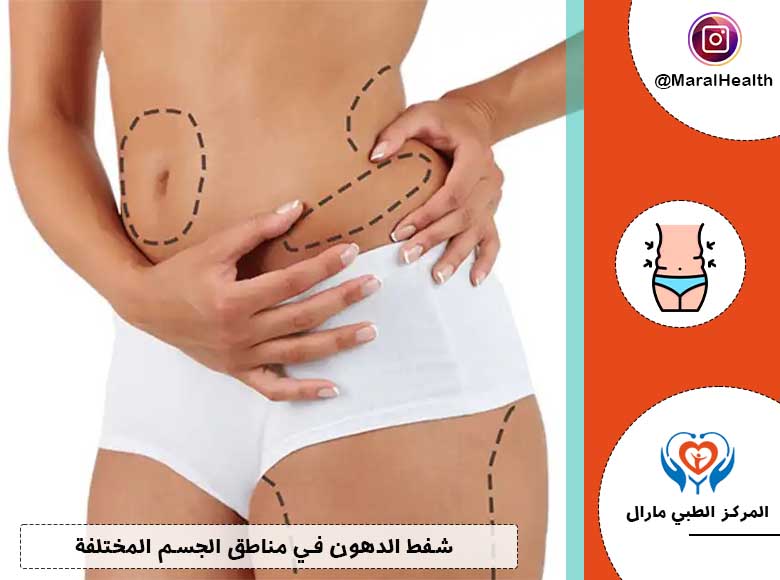 شفط الدهون في مناطق الجسم المختلفة