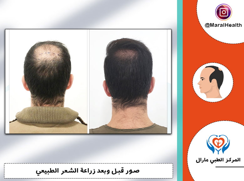 صور زراعة الشعر بالشريحة FUT