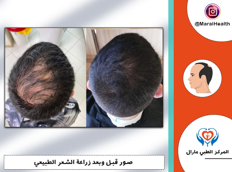 صور لزراعة الشعر DHI