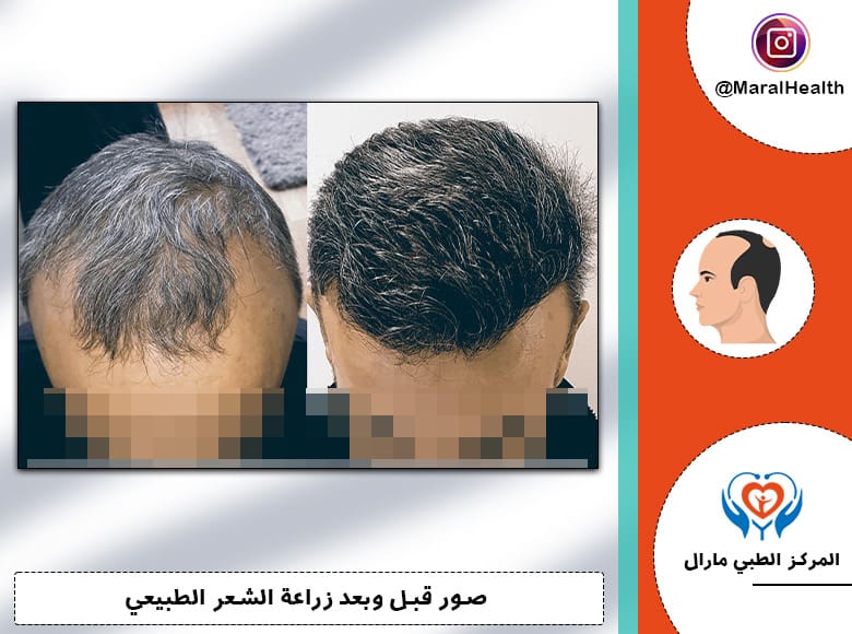 صور لزراعة الشعر بالاقتطاف