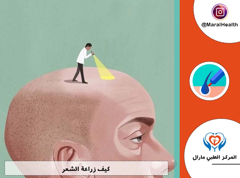 كيف زراعة الشعر؟