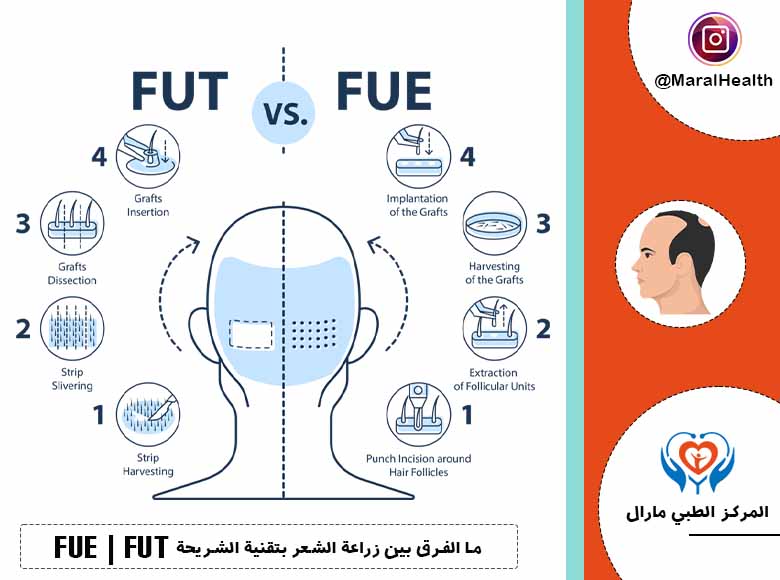 ما الفرق بين زراعة الشعر بتقنية الشريحة FUT و FUE