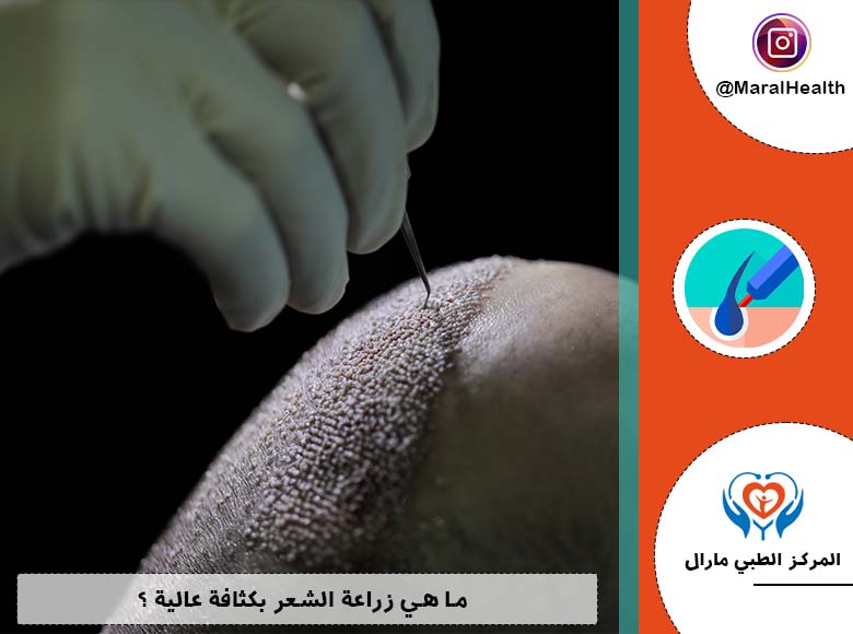 ما هي زراعة الشعر بكثافة عالية ؟