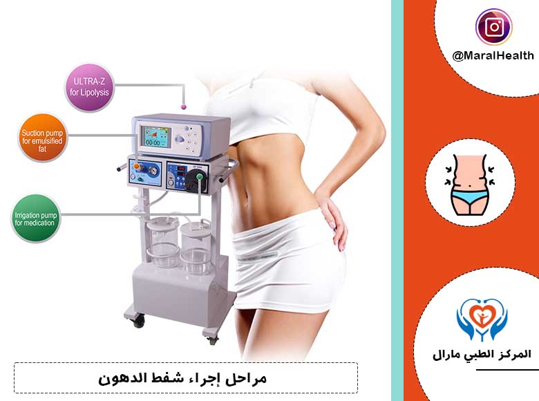 مراحل إجراء شفط الدهون
