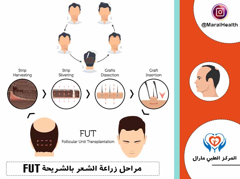 مراحل زراعة الشعر بالشريحة FUT