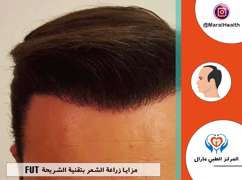 مزايا زراعة الشعر بتقنية الشريحة