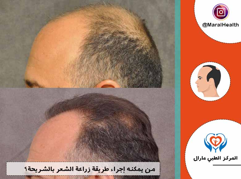من يمكنه إجراء طريقة زراعة الشعر بالشريحة؟