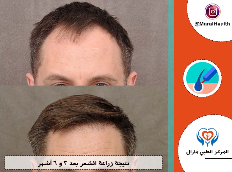نتيجة زراعة الشعر بعد 3 و 6 أشهر
