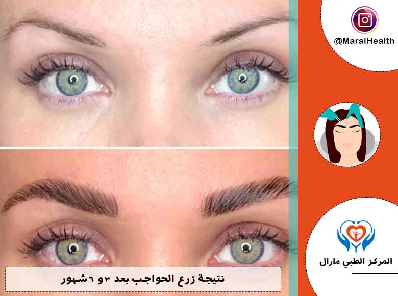 نتيجة زرع الحواجب بعد 3 و 6 شهور