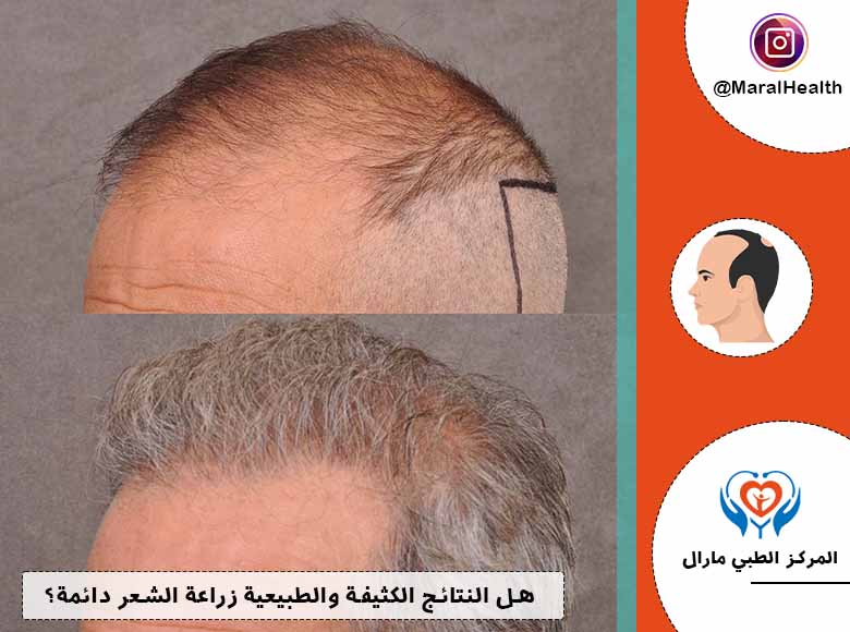 هل النتائج الكثيفة والطبيعية زراعة الشعر دائمة؟
