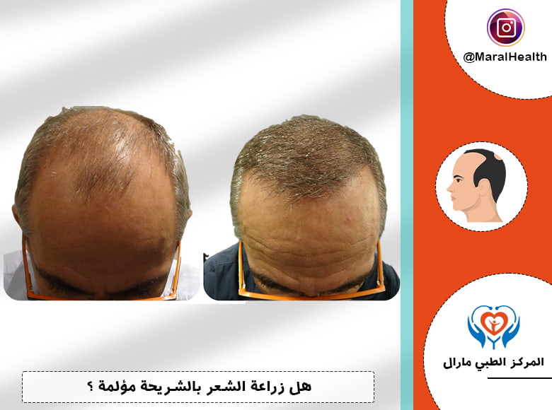هل زراعة الشعر بالشريحة مؤلمة ؟