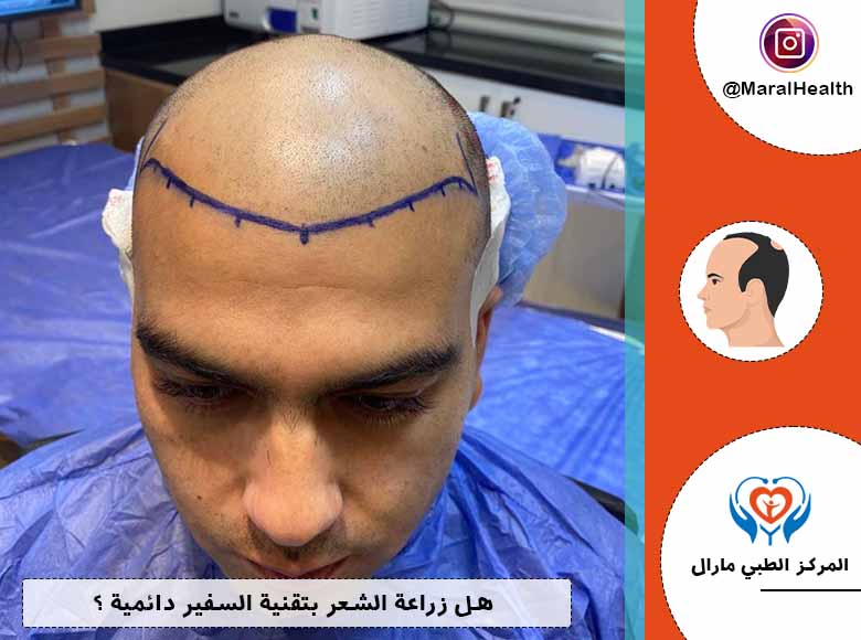 هل زراعة الشعر بتقنية السفير دائمية ؟