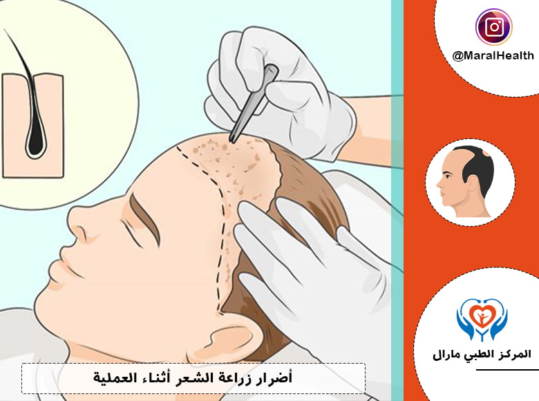 أضرار زراعة الشعر أثناء العملية