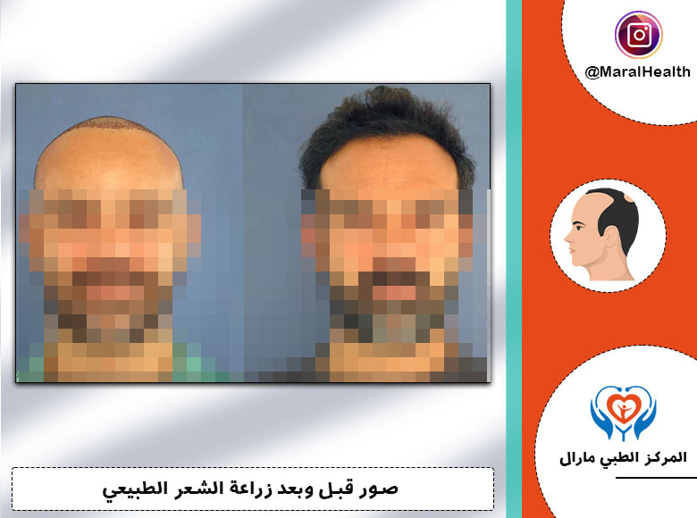 أضرار زراعة الشعر بعد العملية